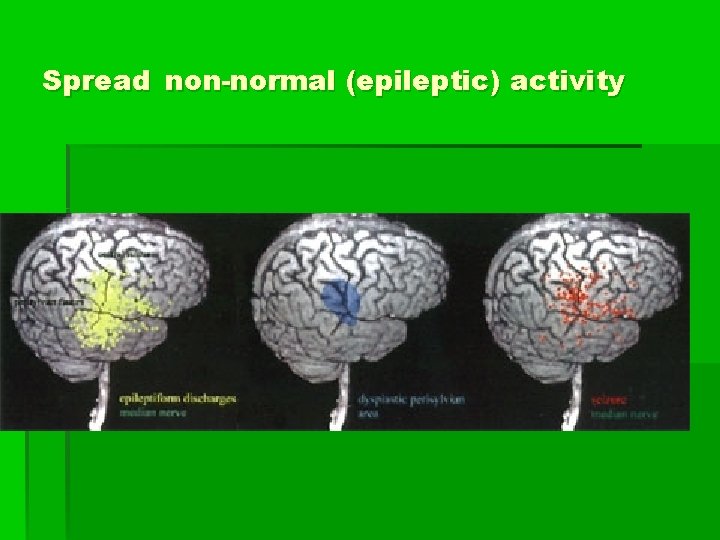 Spread non-normal (epileptic) activity 