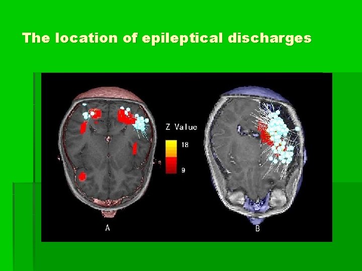 The location of epileptical discharges 