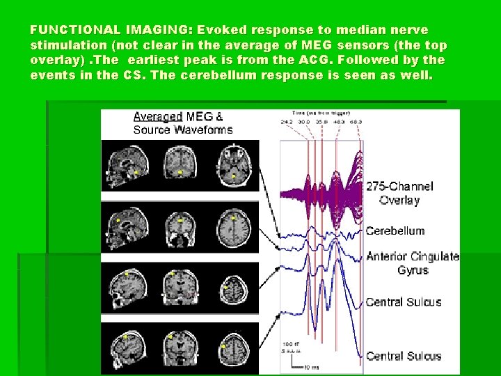 FUNCTIONAL IMAGING: Evoked response to median nerve stimulation (not clear in the average of