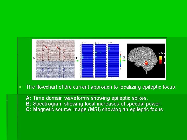 § The flowchart of the current approach to localizing epileptic focus. A: Time domain