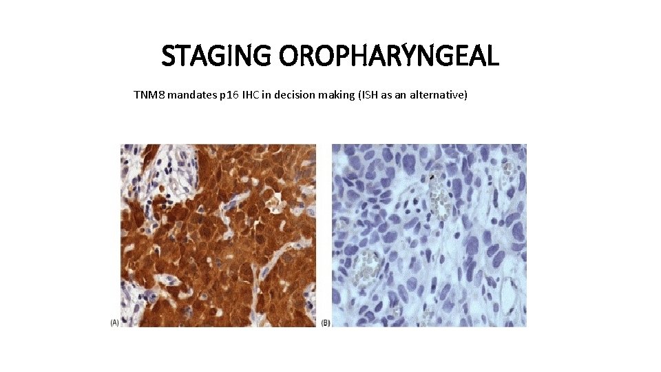 STAGING OROPHARYNGEAL TNM 8 mandates p 16 IHC in decision making (ISH as an