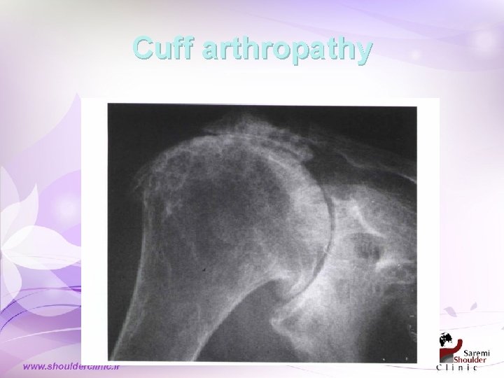 Cuff arthropathy 