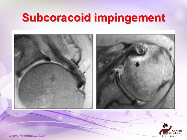 Subcoracoid impingement 