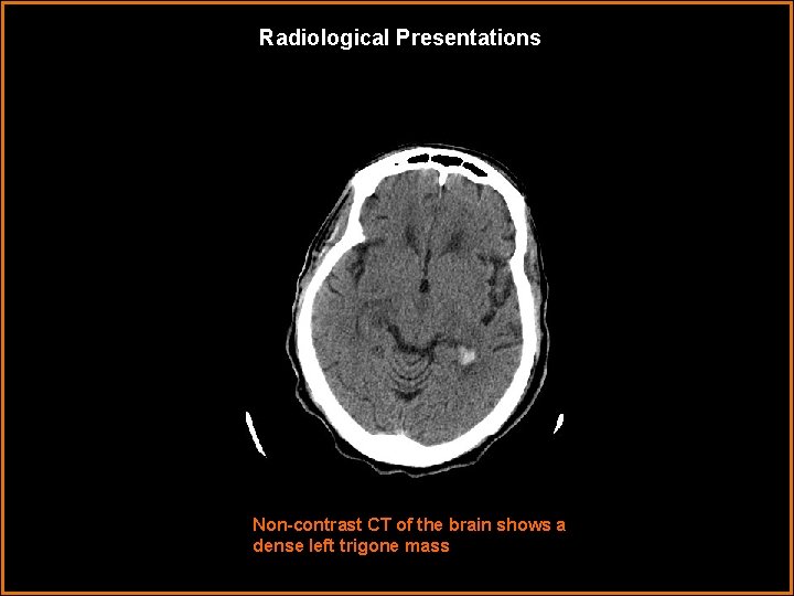 Radiological Presentations Non-contrast CT of the brain shows a dense left trigone mass 