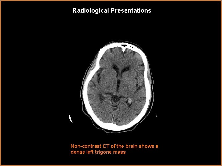 Radiological Presentations Non-contrast CT of the brain shows a dense left trigone mass 