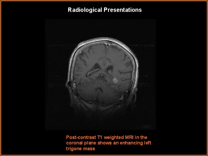Radiological Presentations Post-contrast T 1 weighted MRI in the coronal plane shows an enhancing