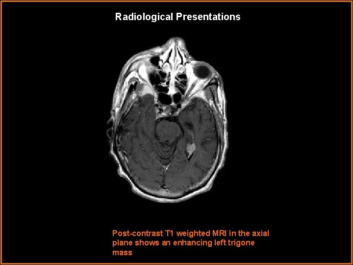 Radiological Presentations Post-contrast T 1 weighted MRI in the axial plane shows an enhancing