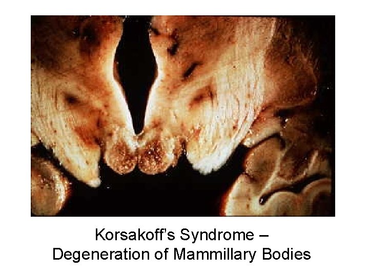 Korsakoff’s Syndrome – Degeneration of Mammillary Bodies 
