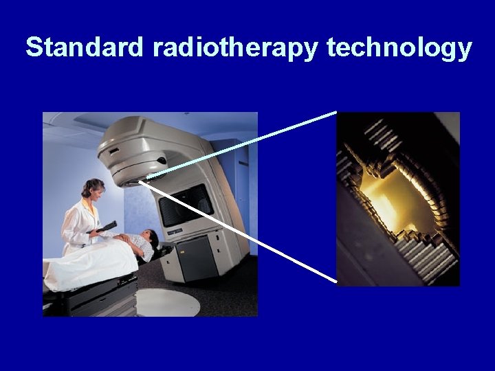 Standard radiotherapy technology 