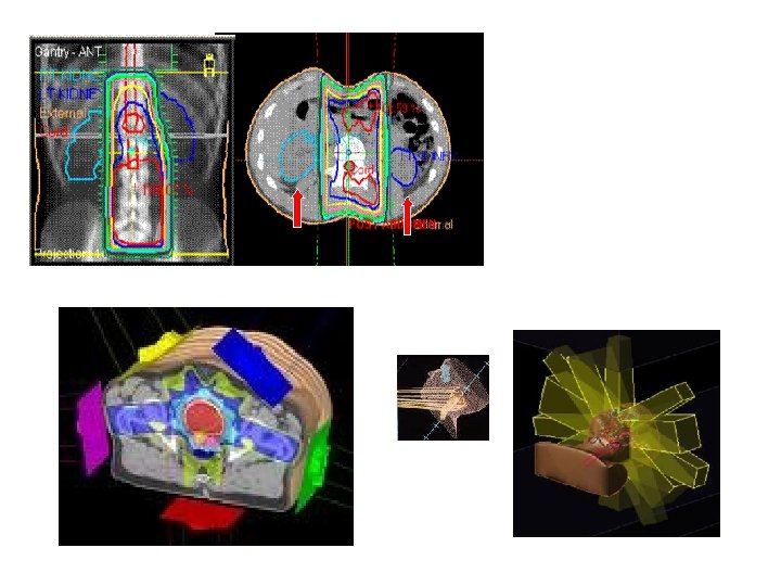 Parallel opposed fields: note ‘hot areas’ in red: increase in proportion to tissue separation