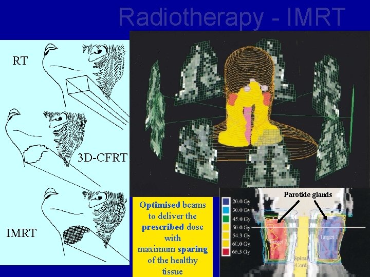 Radiotherapy - IMRT RT 3 D-CFRT Parotide glands IMRT Optimised beams to deliver the