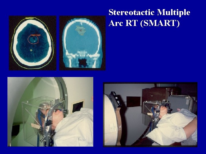 Stereotactic Multiple Arc RT (SMART) 