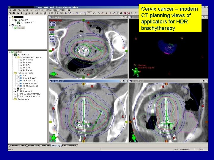 Cervix cancer – modern CT planning views of applicators for HDR brachytherapy 