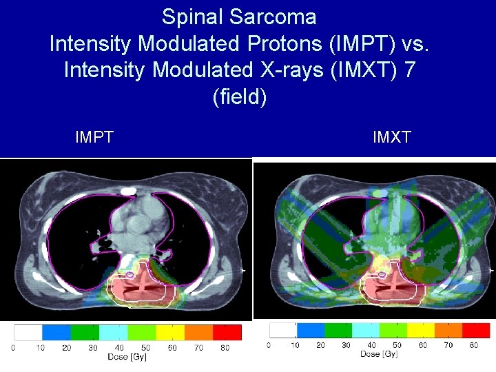 Spinal Sarcoma Intensity Modulated Protons (IMPT) vs. Intensity Modulated X-rays (IMXT) 7 (field) IMPT