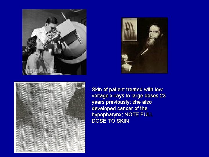 Skin of patient treated with low voltage x-rays to large doses 23 years previously;