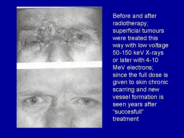 Before and after radiotherapy; superficial tumours were treated this way with low voltage 50