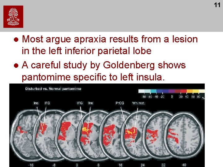 11 Most argue apraxia results from a lesion in the left inferior parietal lobe