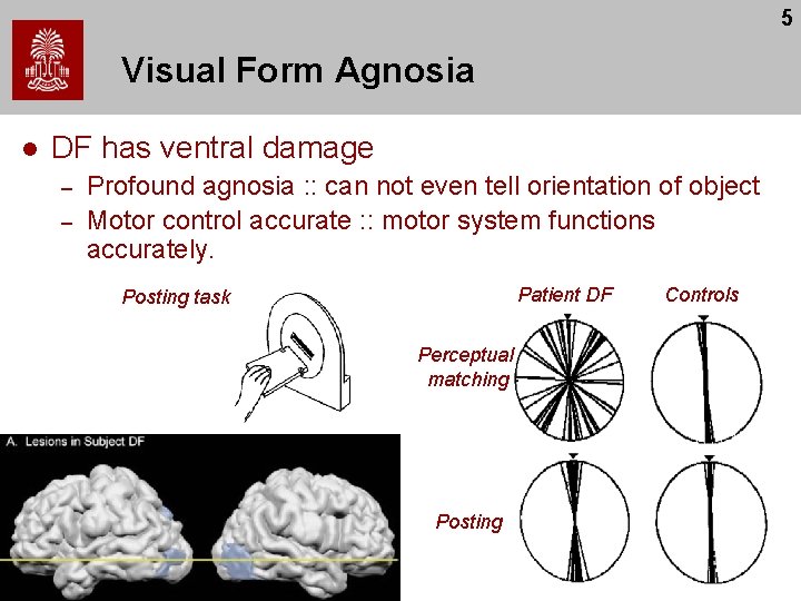 5 Visual Form Agnosia l DF has ventral damage – – Profound agnosia :