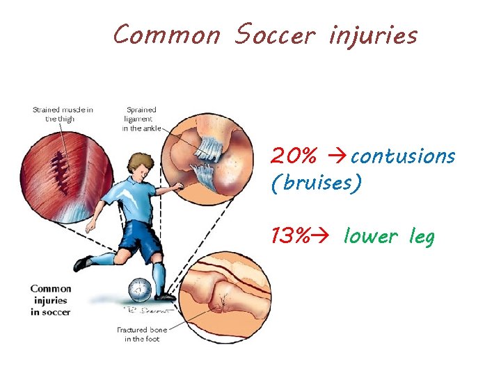 Common Soccer injuries 20% contusions (bruises) 13% lower leg 