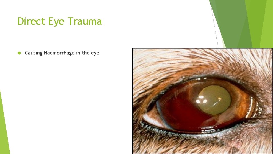 Direct Eye Trauma Causing Haemorrhage in the eye 
