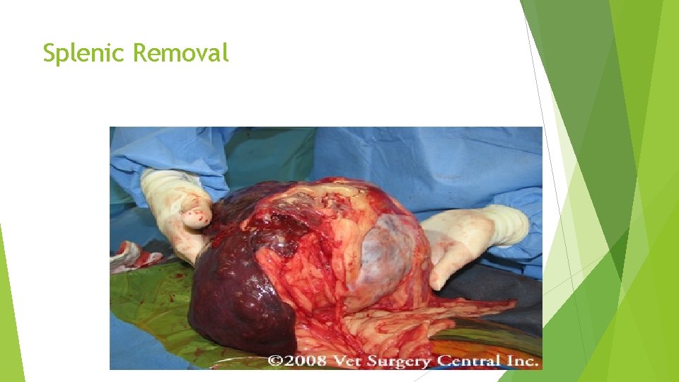 Splenic Removal 