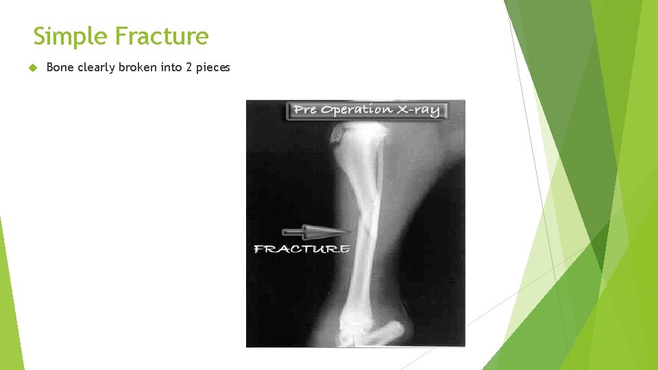 Simple Fracture Bone clearly broken into 2 pieces 