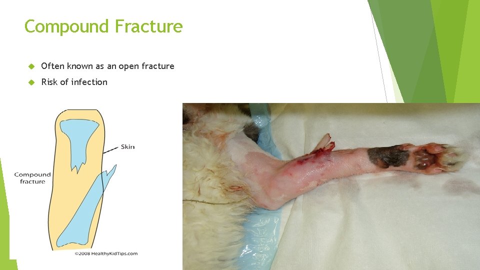 Compound Fracture Often known as an open fracture Risk of infection 