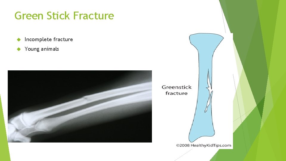 Green Stick Fracture Incomplete fracture Young animals 