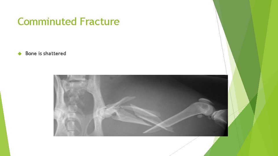 Comminuted Fracture Bone is shattered 