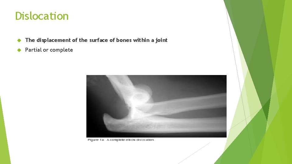 Dislocation The displacement of the surface of bones within a joint Partial or complete