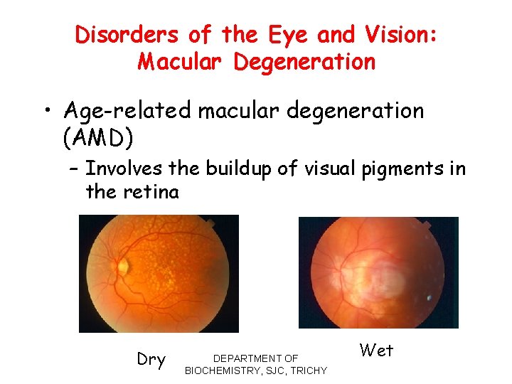 Disorders of the Eye and Vision: Macular Degeneration • Age-related macular degeneration (AMD) –