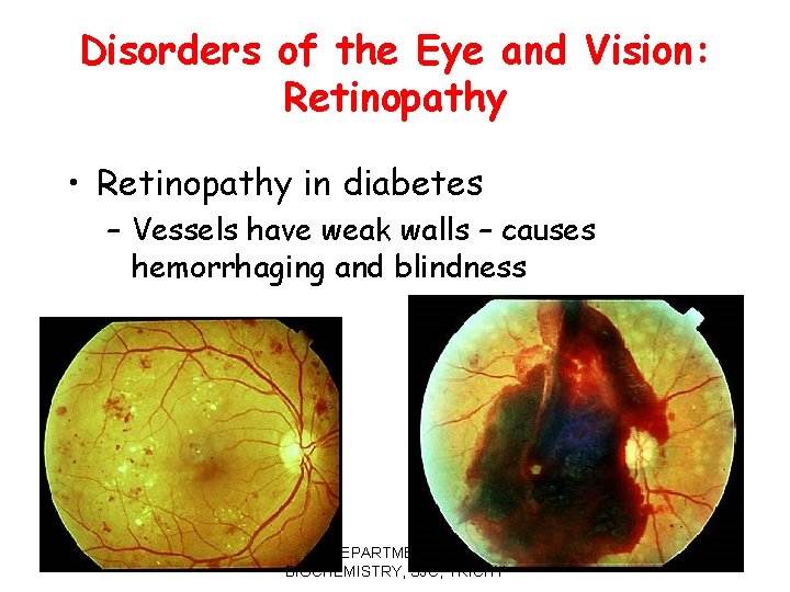 Disorders of the Eye and Vision: Retinopathy • Retinopathy in diabetes – Vessels have