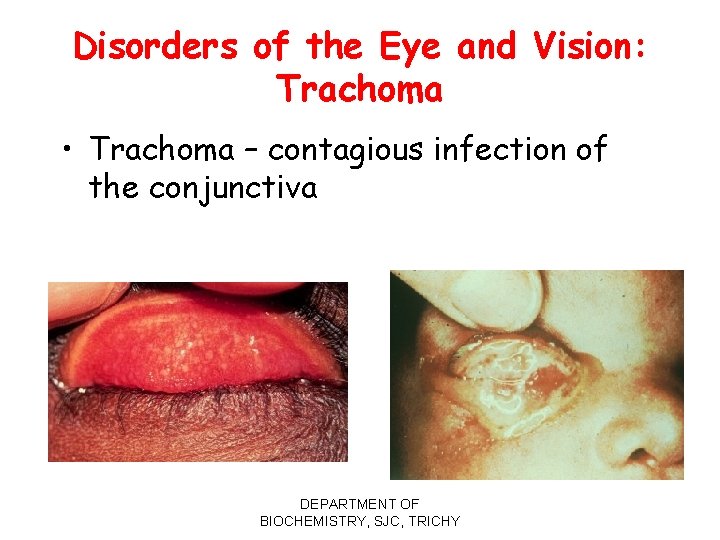 Disorders of the Eye and Vision: Trachoma • Trachoma – contagious infection of the
