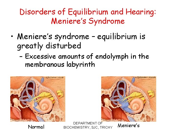 Disorders of Equilibrium and Hearing: Meniere’s Syndrome • Meniere’s syndrome – equilibrium is greatly