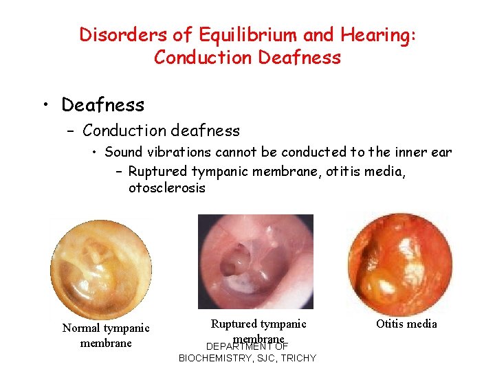 Disorders of Equilibrium and Hearing: Conduction Deafness • Deafness – Conduction deafness • Sound