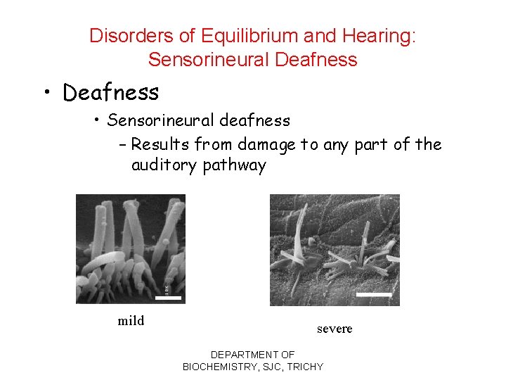 Disorders of Equilibrium and Hearing: Sensorineural Deafness • Deafness • Sensorineural deafness – Results