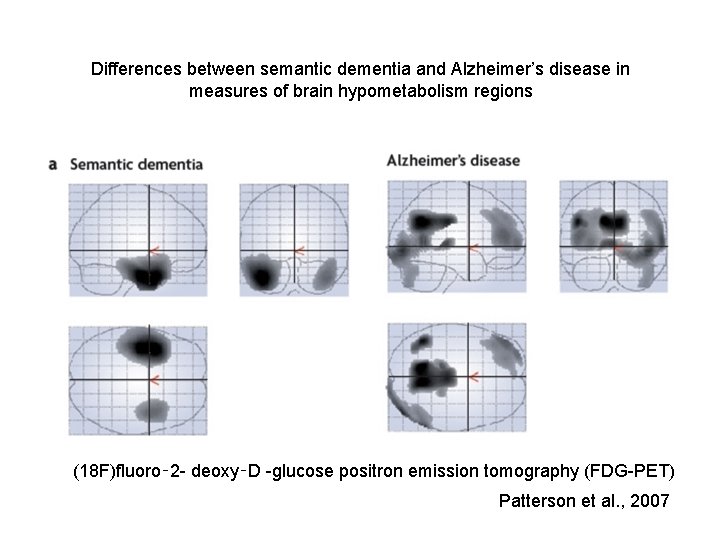 Differences between semantic dementia and Alzheimer’s disease in measures of brain hypometabolism regions (18