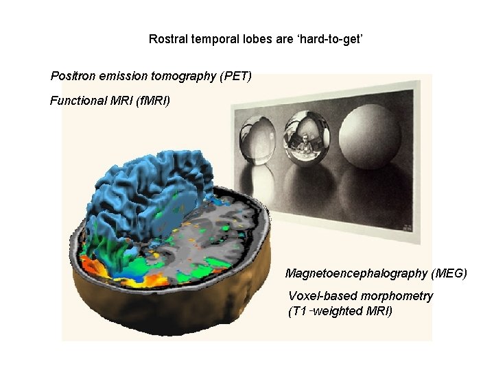 Rostral temporal lobes are ‘hard-to-get’ Positron emission tomography (PET) Functional MRI (f. MRI) Magnetoencephalography