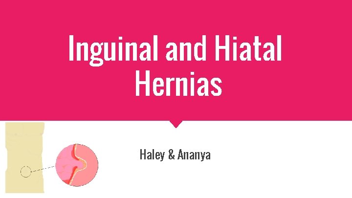 Inguinal and Hiatal Hernias Haley & Ananya 