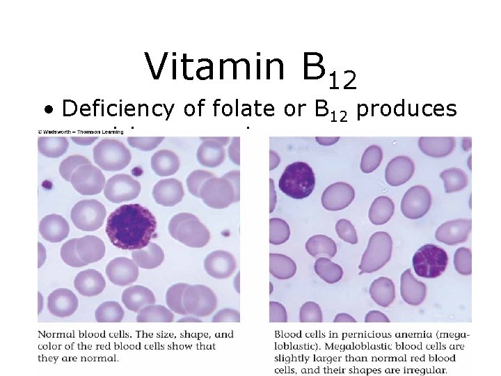Vitamin B 12 • Deficiency of folate or B 12 produces pernicious anemia 