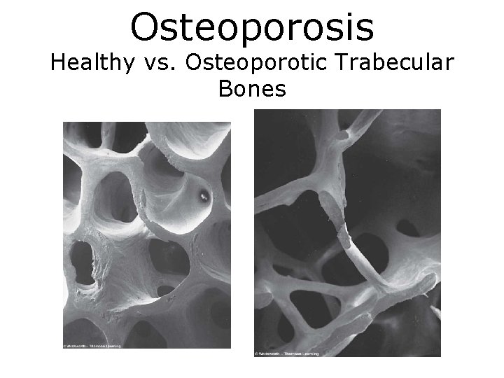 Osteoporosis Healthy vs. Osteoporotic Trabecular Bones 