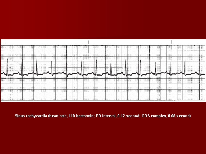 Sinus tachycardia (heart rate, 110 beats/min; PR interval, 0. 12 second; QRS complex, 0.