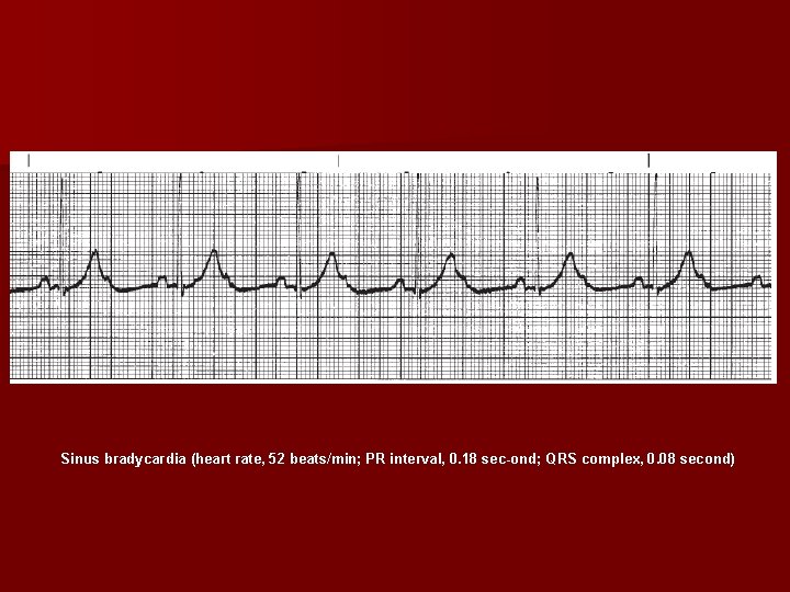 Sinus bradycardia (heart rate, 52 beats/min; PR interval, 0. 18 sec ond; QRS complex,