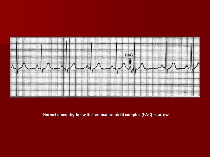 Normal sinus rhythm with a premature atrial complex (PAC) at arrow 