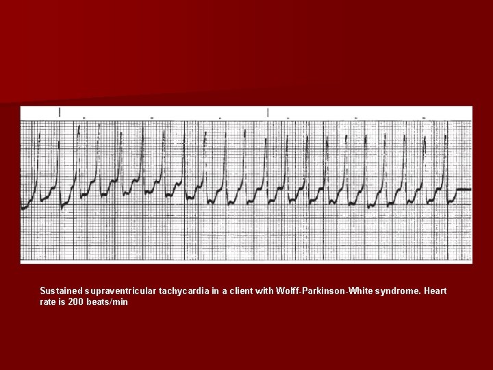 Sustained supraventricular tachycardia in a client with Wolff Parkinson White syndrome. Heart rate is