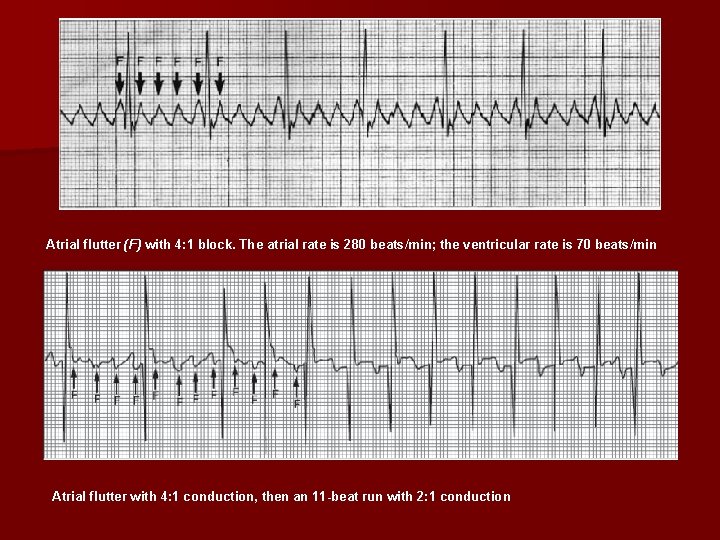 Atrial flutter (F) with 4: 1 block. The atrial rate is 280 beats/min; the