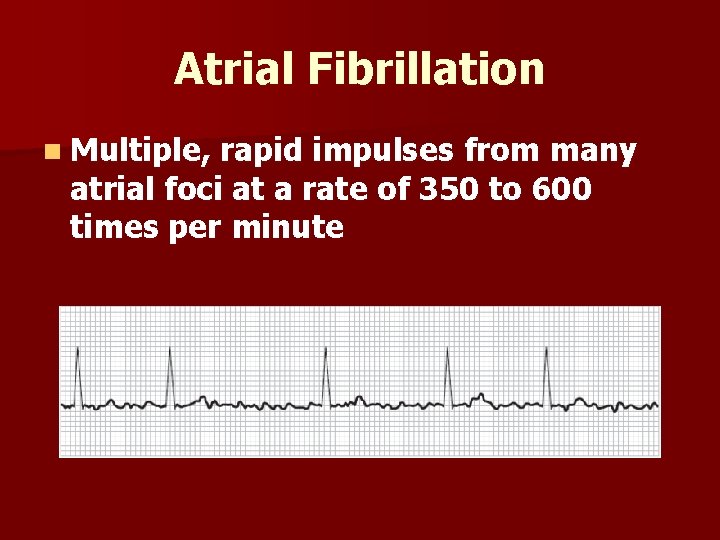 Atrial Fibrillation n Multiple, rapid impulses from many atrial foci at a rate of
