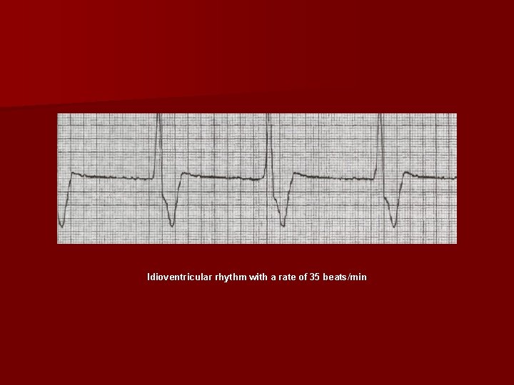 Idioventricular rhythm with a rate of 35 beats/min 