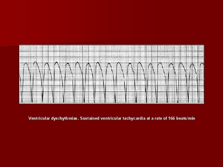 Ventricular dysrhythmias. Sustained ventricular tachycardia at a rate of 166 beats/min 