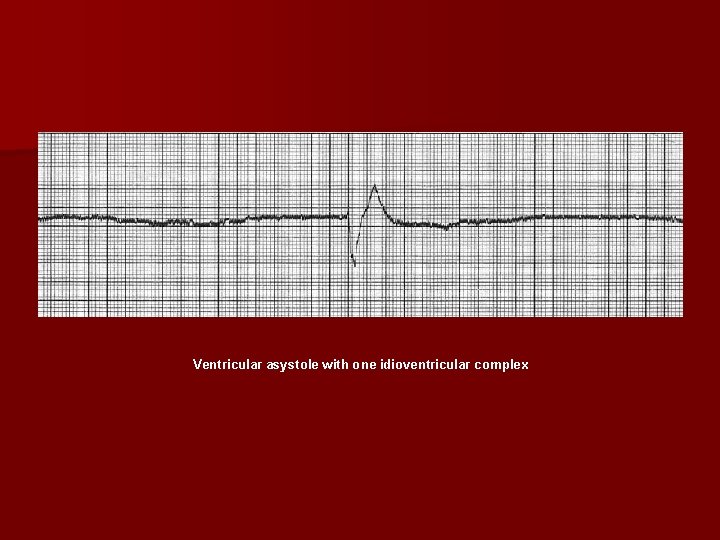 Ventricular asystole with one idioventricular complex 